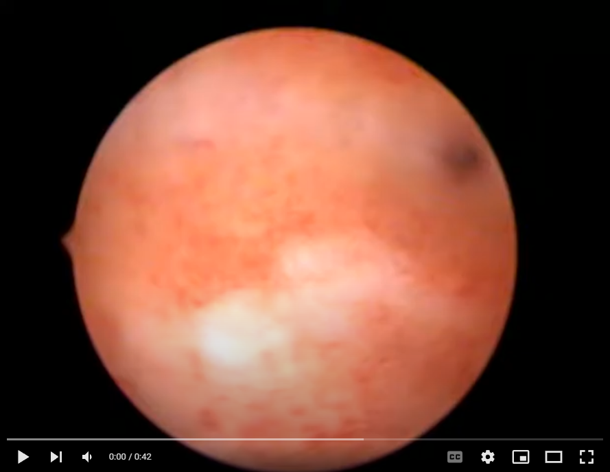 Jak je velký polyp?